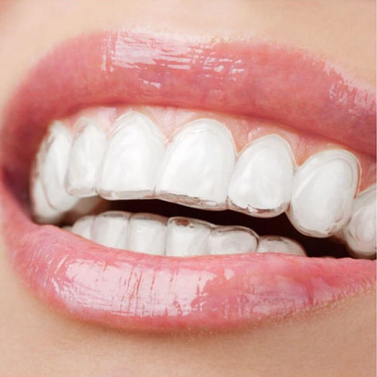 An image of an invisalign on a placed on teeth