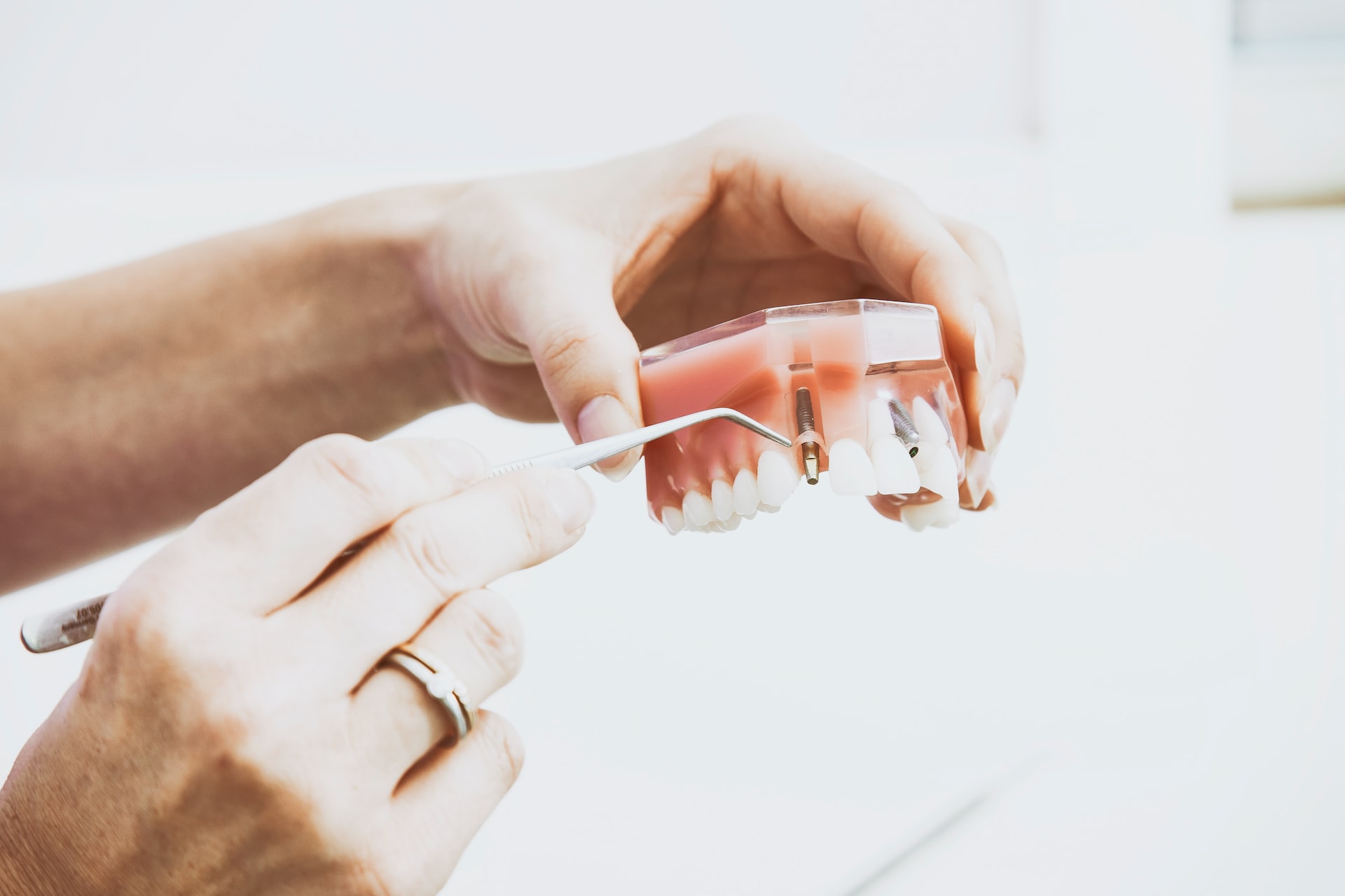 an image of a dentist displaying how can you get dental implants with receding gums