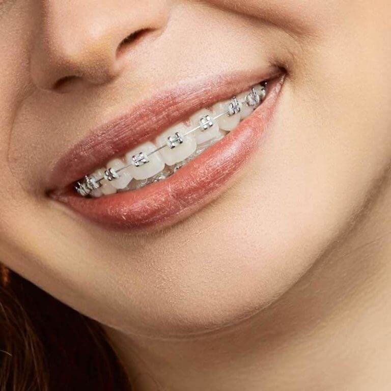 close up of a girl smiling with ceramic braces