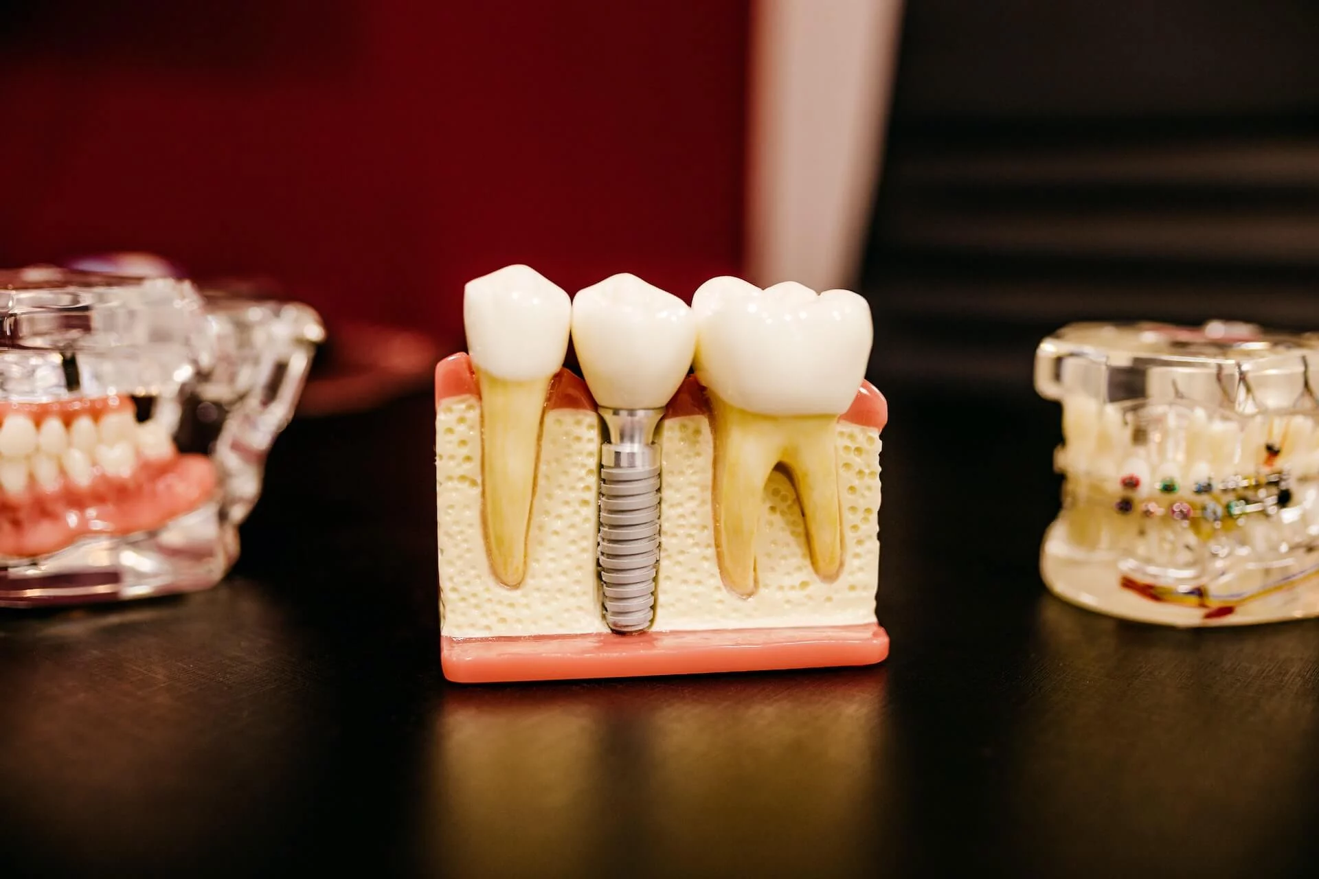 an image of example of how implant will fit in the gum