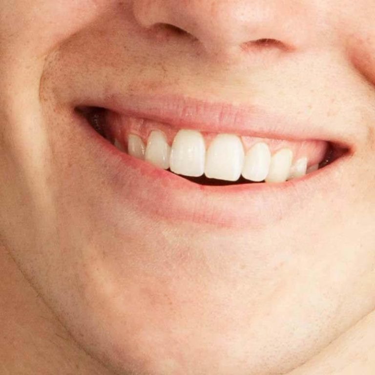 close up of a man smiling after he's had his aligners took off