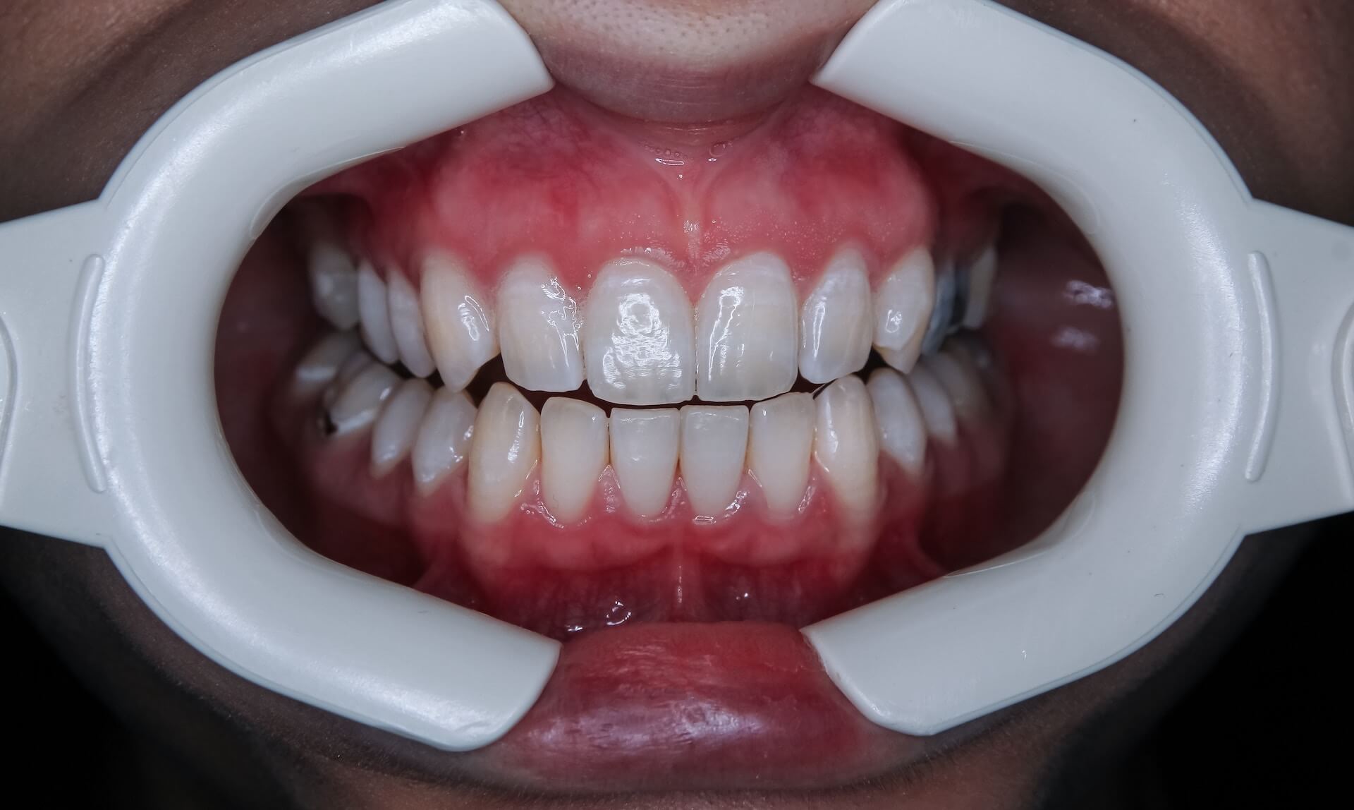 Someones teeth ready to choose either Invisalign or braceschoose either